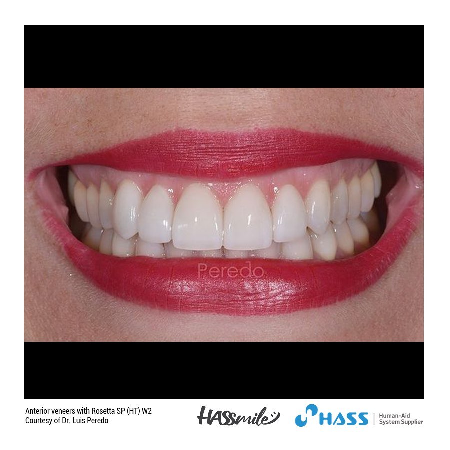Anterior veneers with Rosetta SP (HT) W2 from 13 to 22