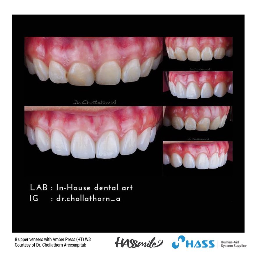 8 upper 8 upper veneers with Amber Press (HT) W3