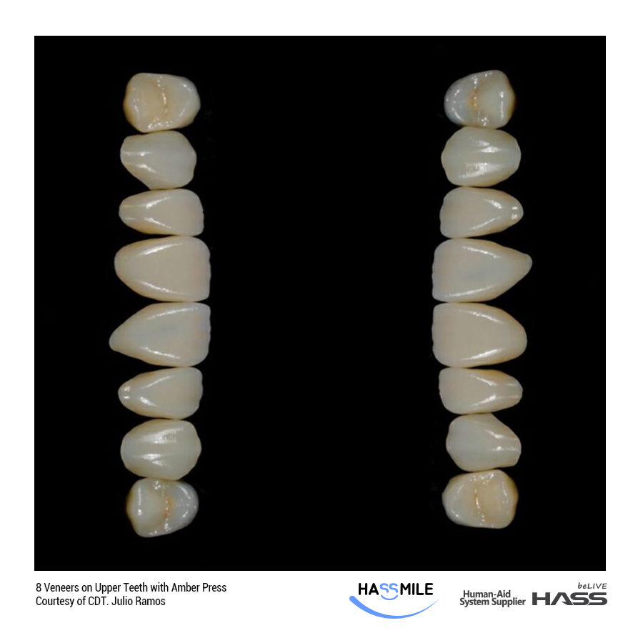 8 Veneers on Upper Teeth with Amber Press (LT)