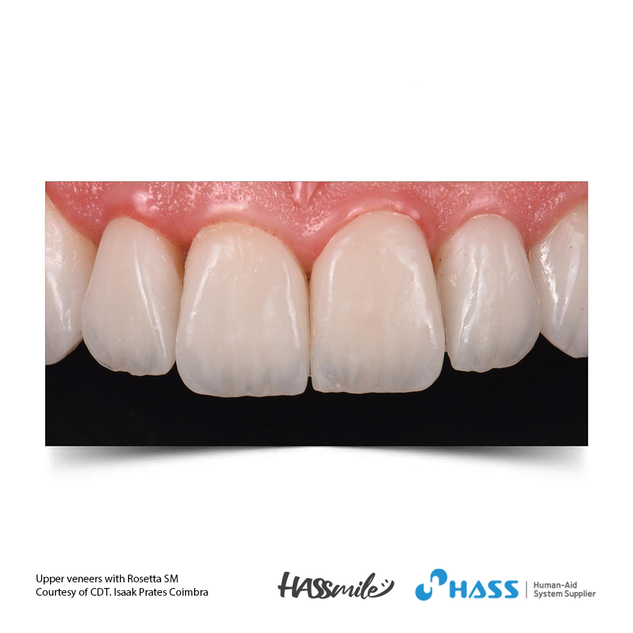 Upper veneers with Rosetta SM