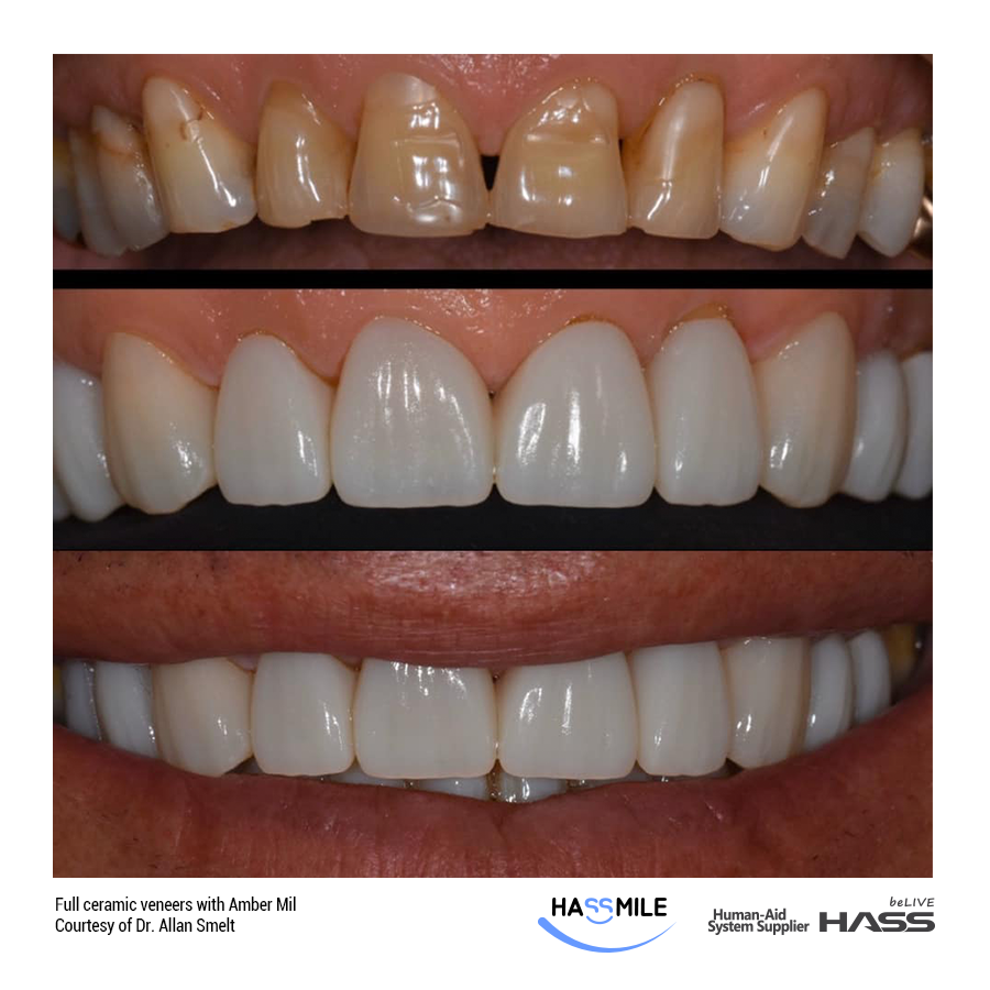 Full ceramic veneers with Amber Mill