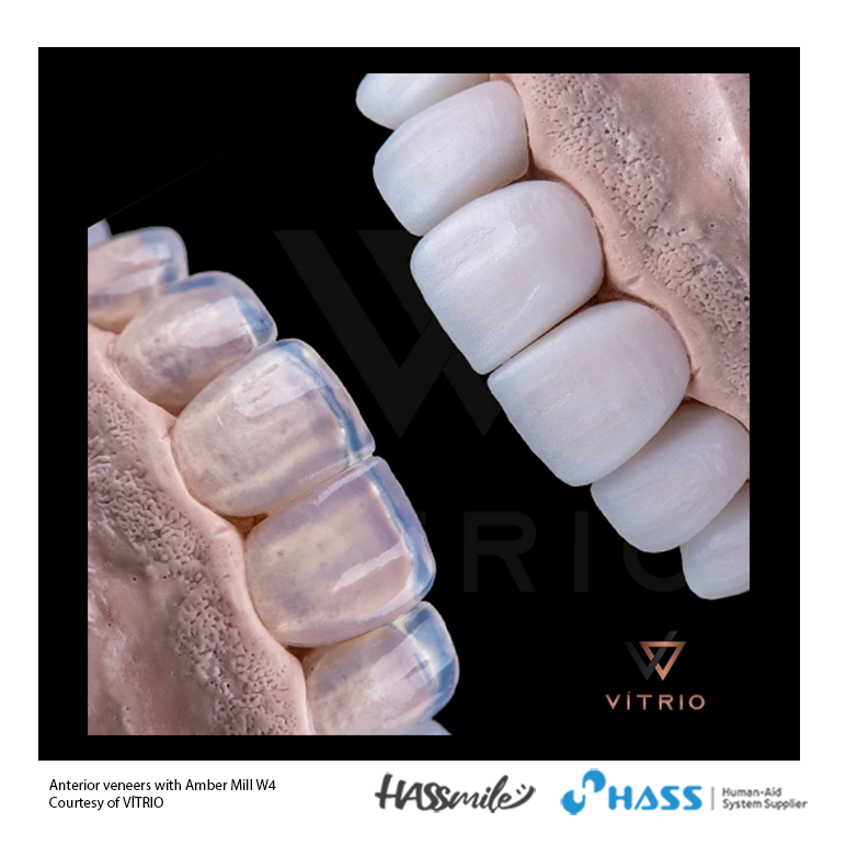 Anterior veneers with Amber Mill W4