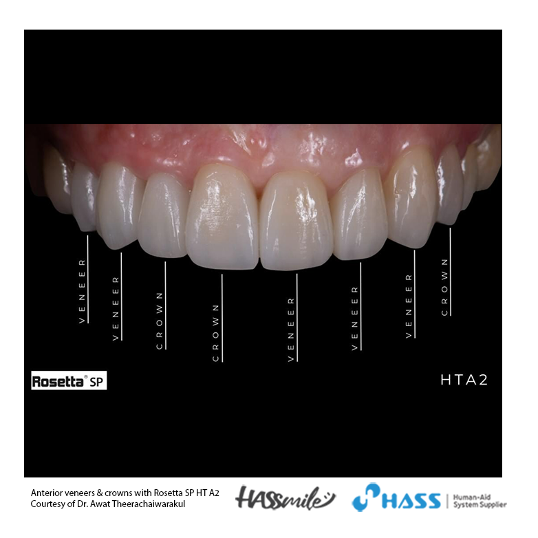 Anterior veneers & crowns with Rosetta SP HT A2