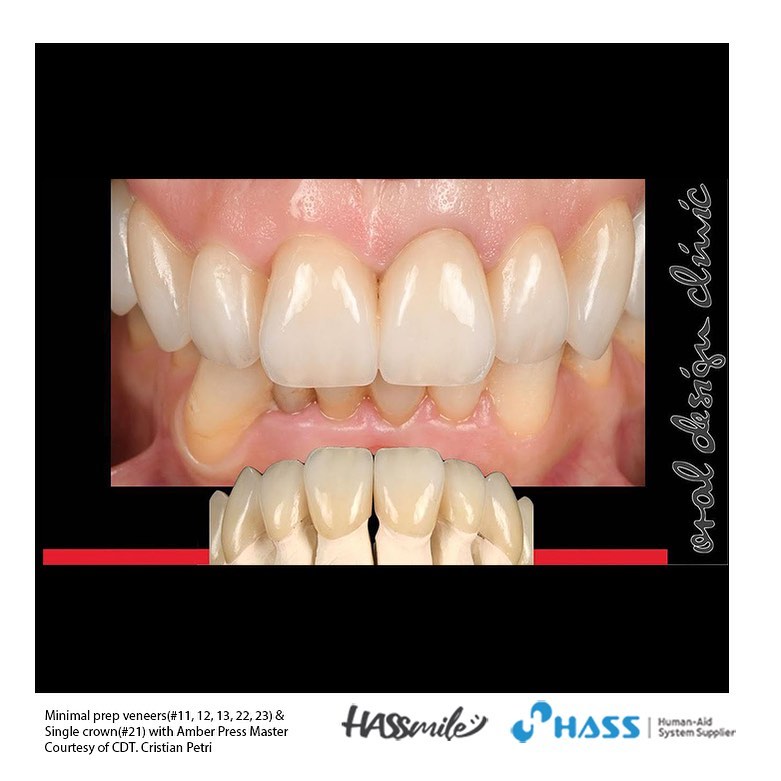 Minimal prep veneers(#11, 12, 13, 22, 23) & Single crown(#21) with Amber Press Master