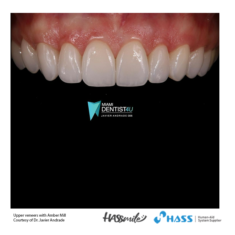 Upper veneers with Amber Mill