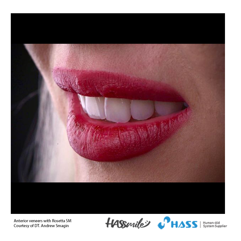 Anterior veneers with Rosetta SM