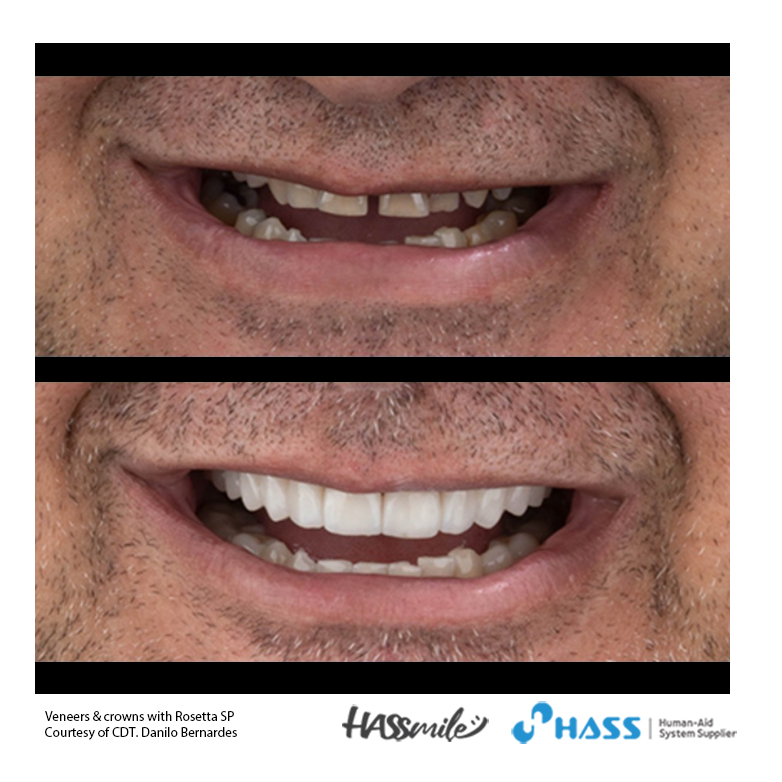 Veneers & crowns with Rosetta SP