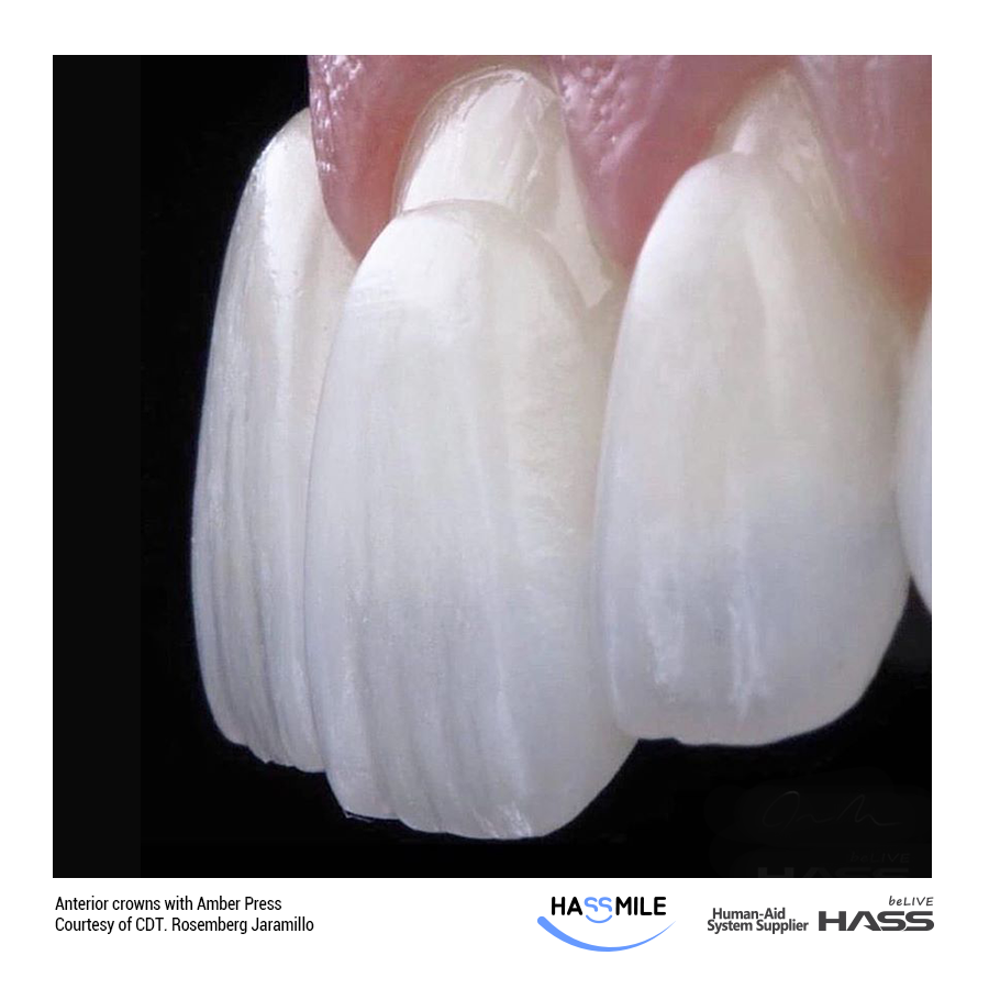 Anterior crowns with Amber Press
