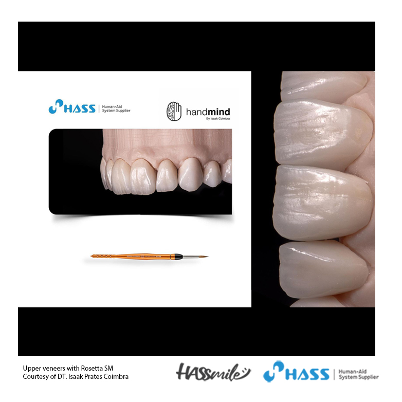 Upper veneers with Rosetta SM