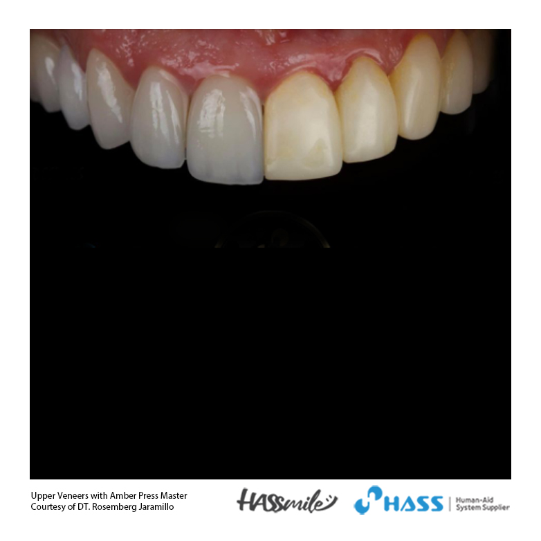 Upper Veneers with Amber Press Master