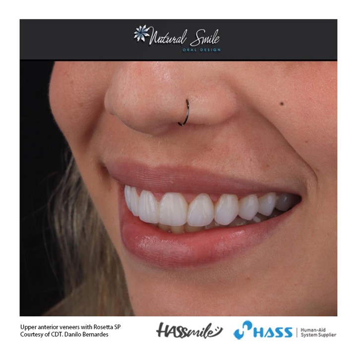 Upper anterior veneers with Rosetta SP