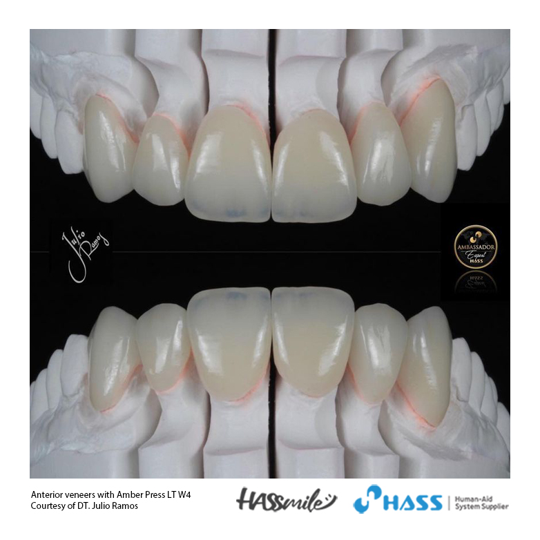 Anterior veneers with Amber Press LT W4