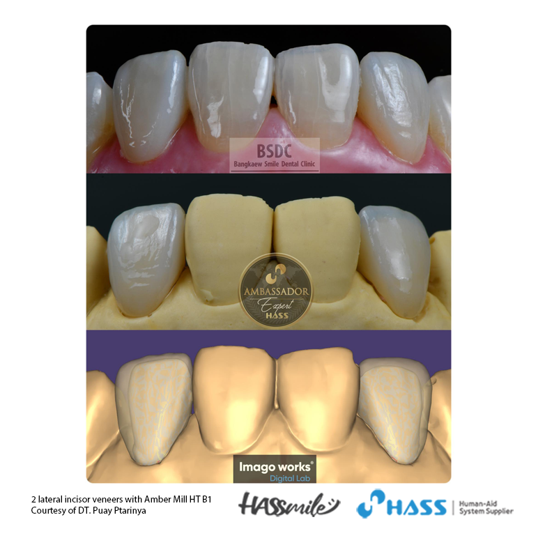 2 lateral incisor veneers with Amber Mill HT B1