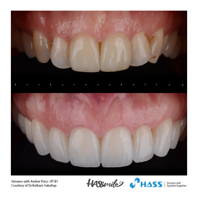 Veneers with Amber press HT B1