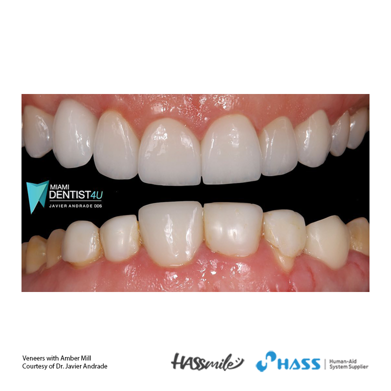 Upper veneers with Amber Mill