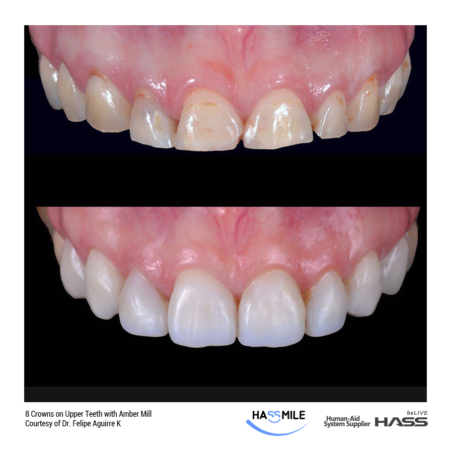 8 Crowns on Upper Teeth with Amber Mill