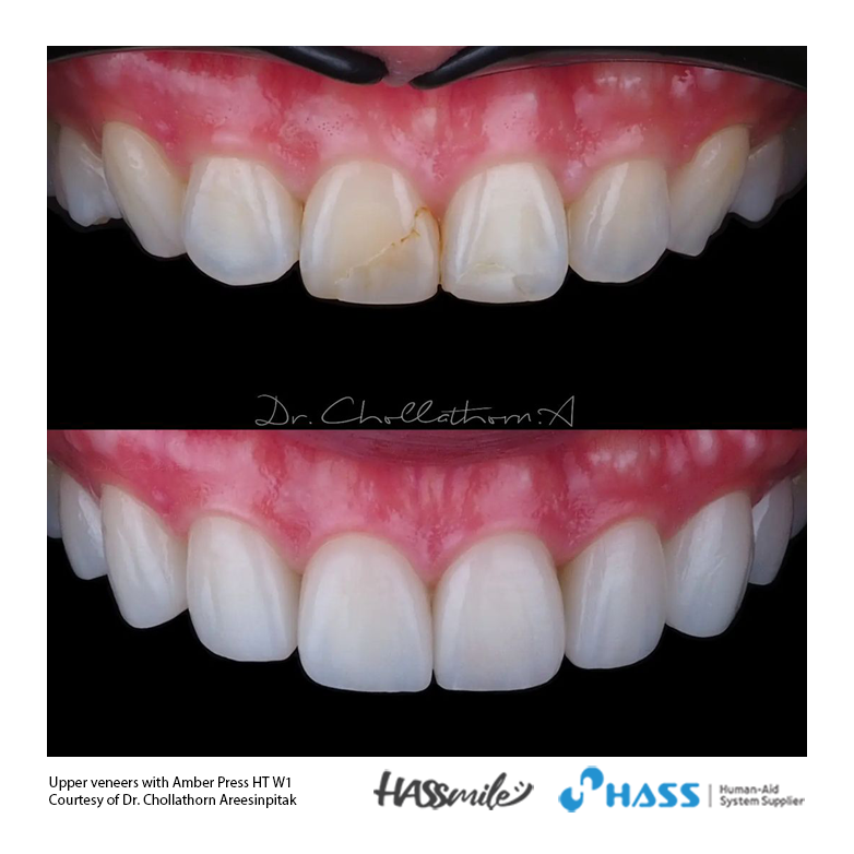 Upper veneers with Amber Press HT W1