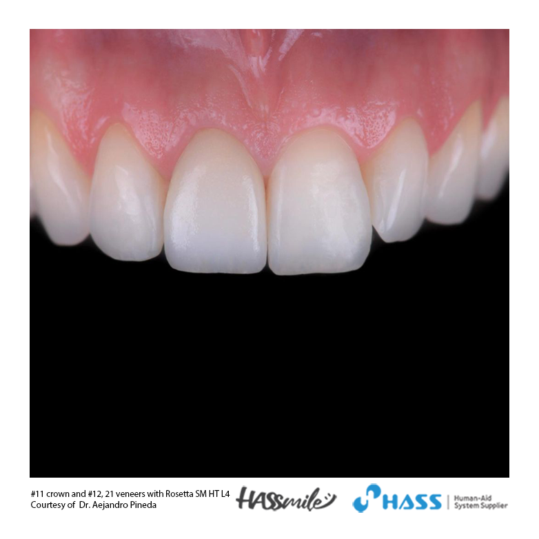#11 crown and #12, 21 veneers with Rosetta SM HT L4