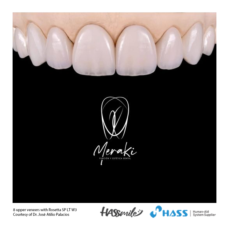 8 upper veneers with Rosetta SP LT W3