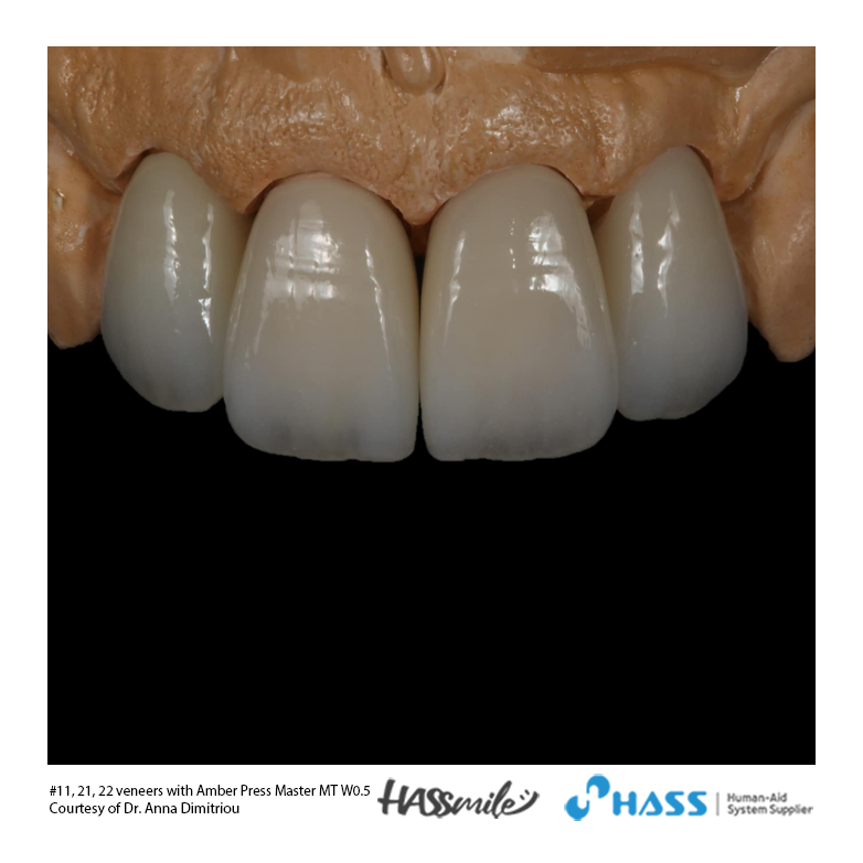 #11, 21, 22 veneers with Amber Press Master MT W0.5