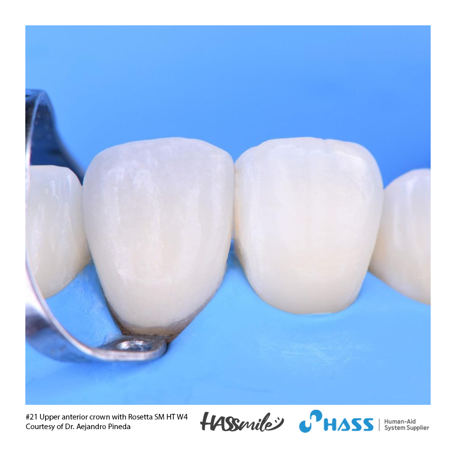 #21 Upper anterior crown with Rosetta SM HT W4