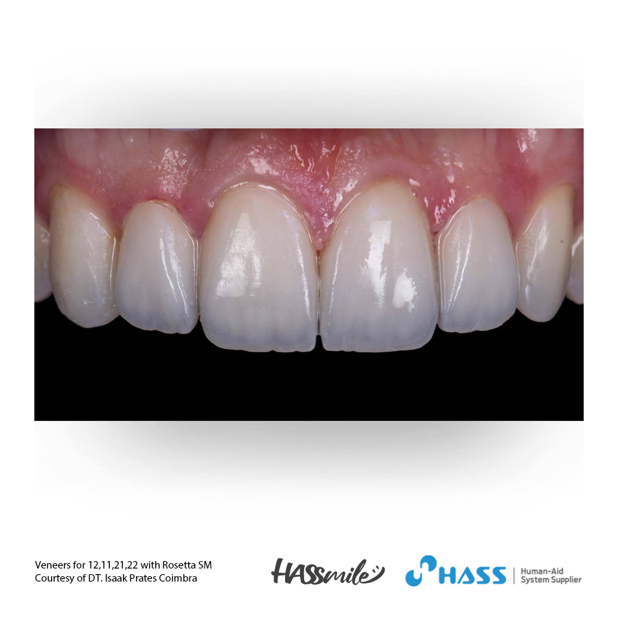 Veneers for 12,11,21,22 with Rosetta SM
