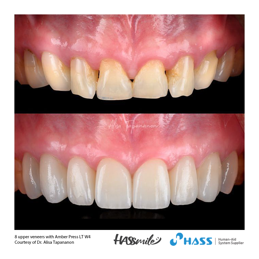 8 upper veneers with Amber Press LT W4