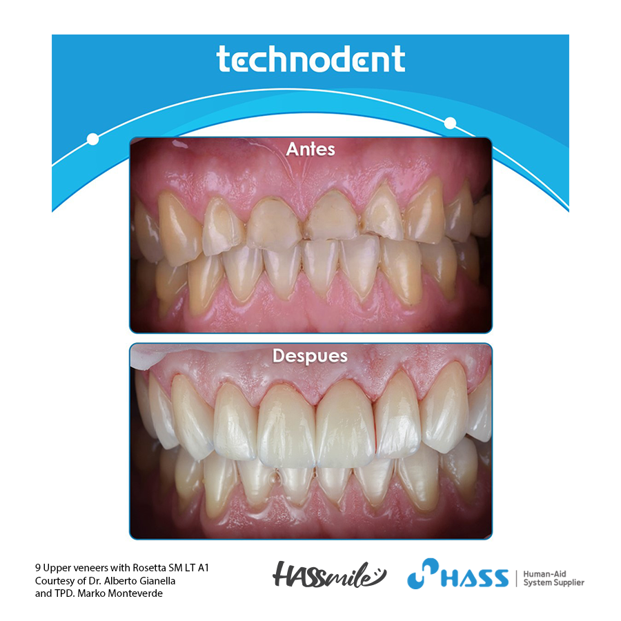 9 Upper veneers with Rosetta SM LT A1