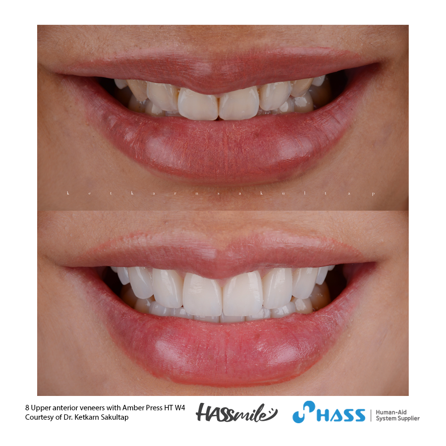 8 Upper anterior veneers with Amber Press HT W4