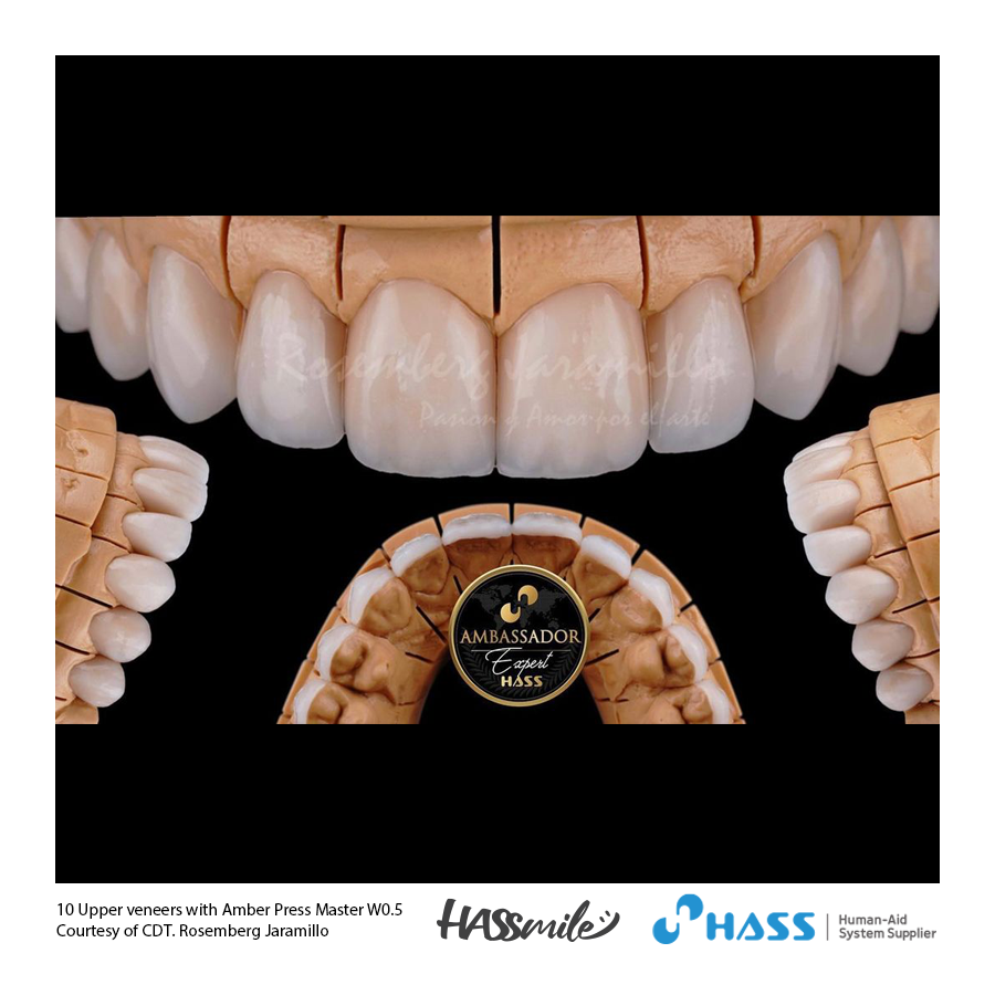 10 Upper veneers with Amber Press Master W0.5