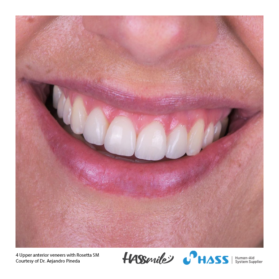 4 Upper anterior veneers with Rosetta SM