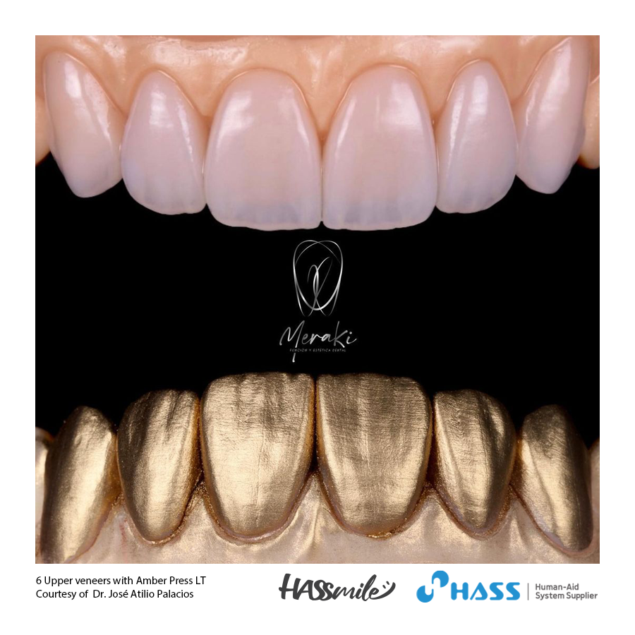 6 Upper veneers with Amber Press LT