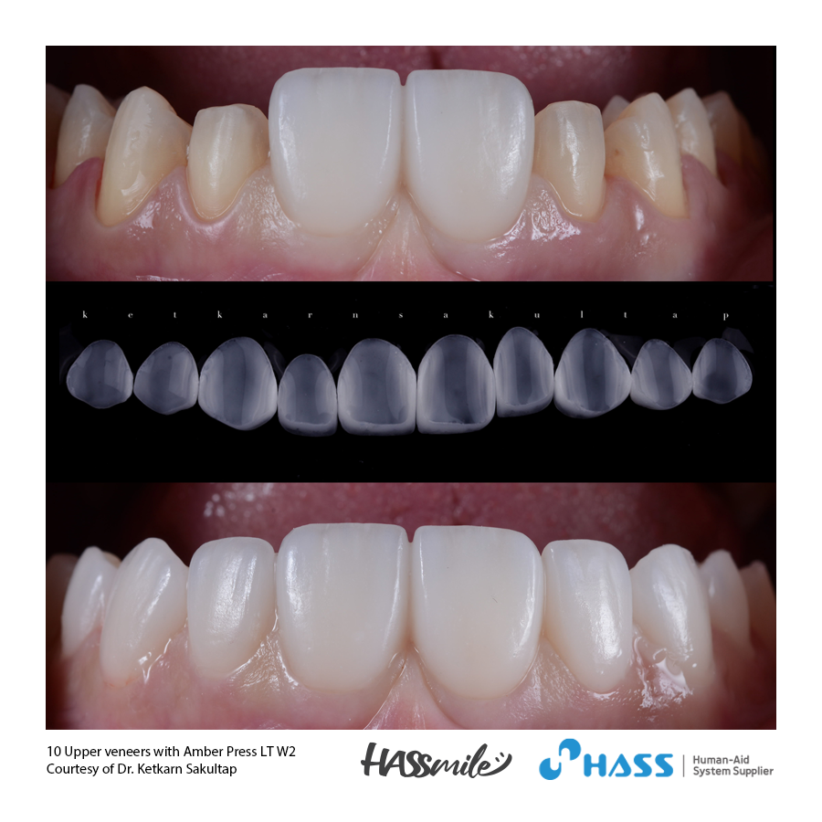 10 Upper veneers with Amber Press LT W2