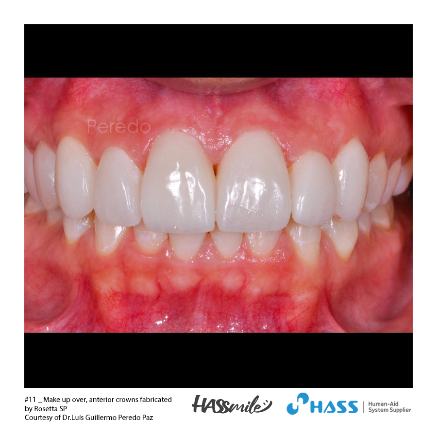#11 _ Make up over, anterior crowns fabricated by Rosetta SP