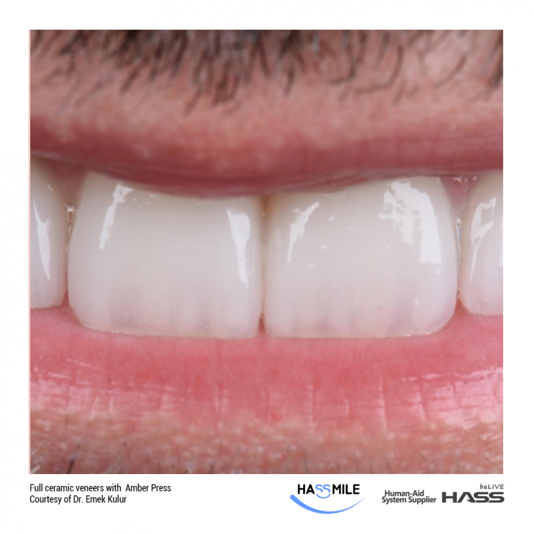 HASS AmberPress dental ceramic
