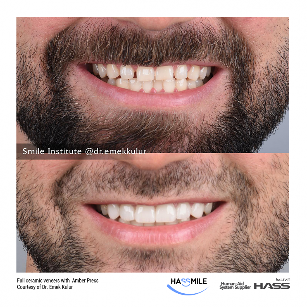 HASS AmberPress dental ceramic