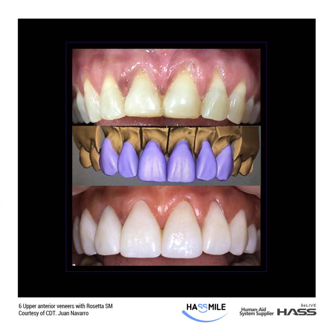 HASSBIO RosettaSM CADCAM