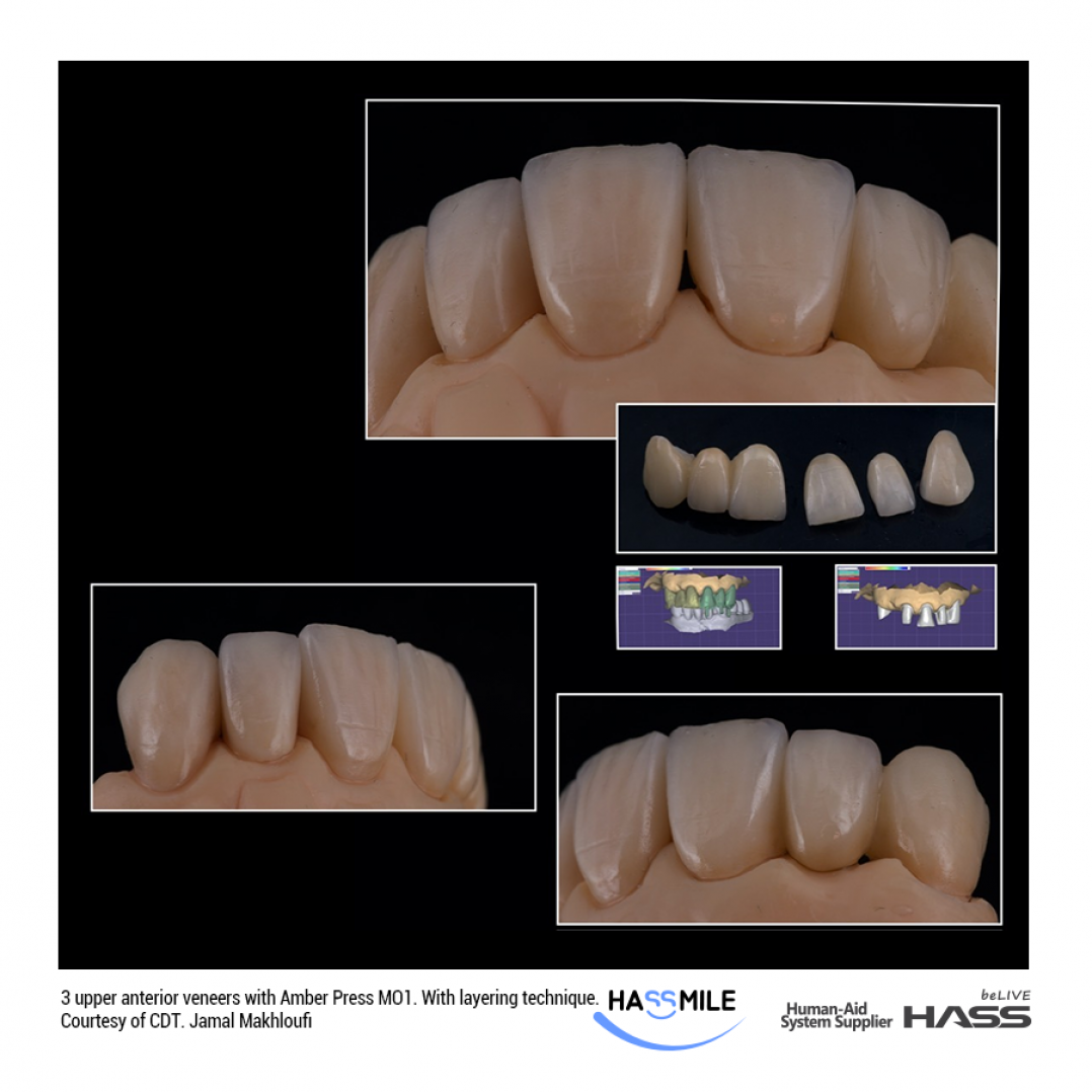 HASS HASSthetics AmberPress zirconia