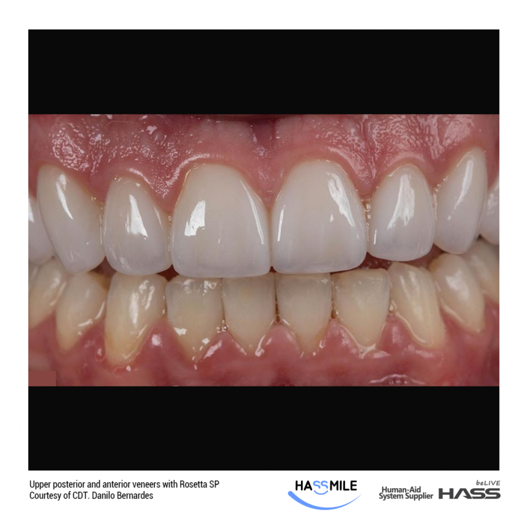 HASSBIO RosettaSP anterior-veneers