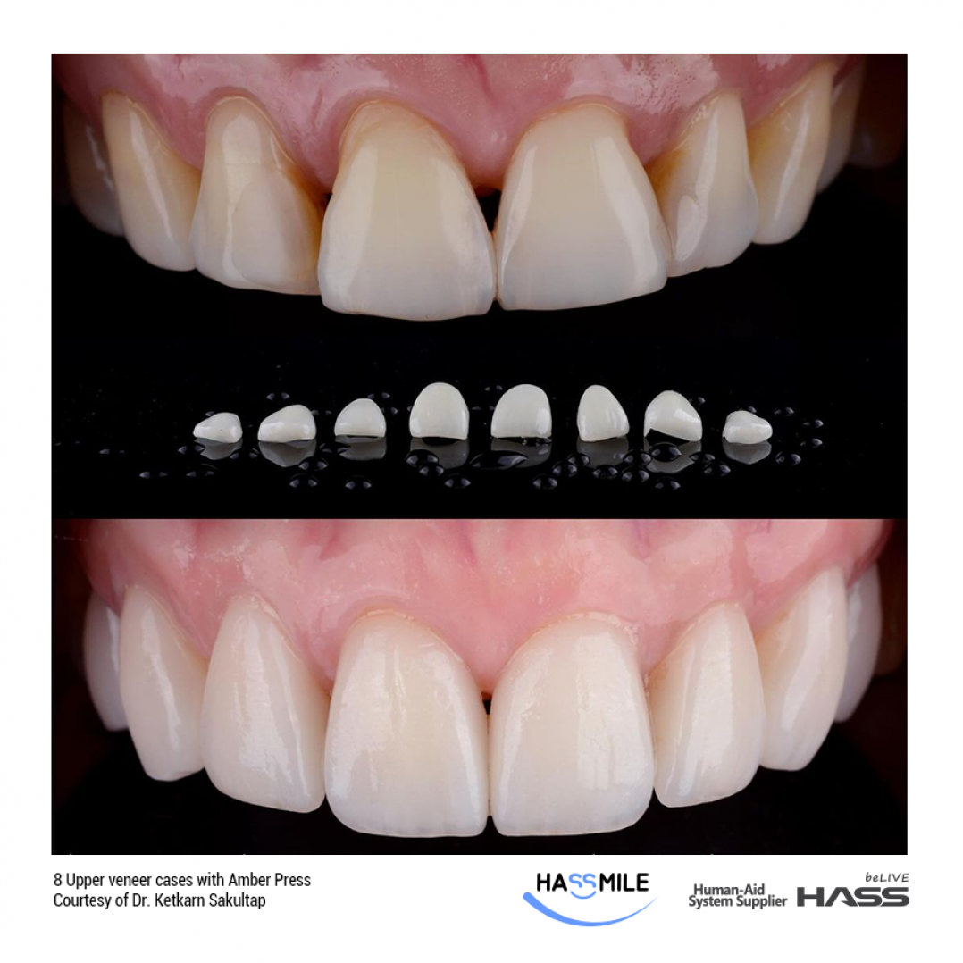 HASSBIO AmberPress ceramic-veneers