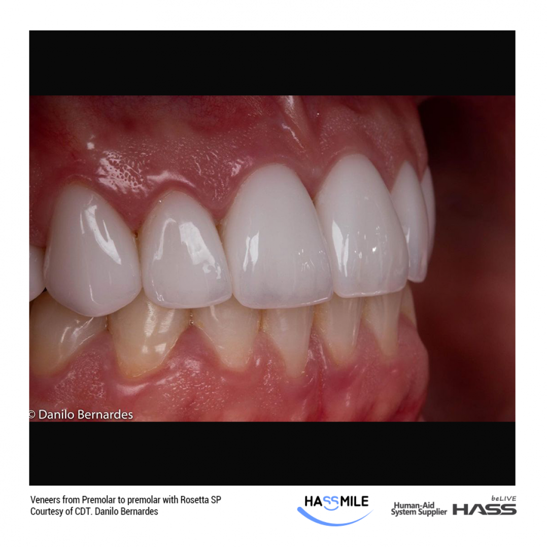 HASS RosettaSP hassthetics veneer