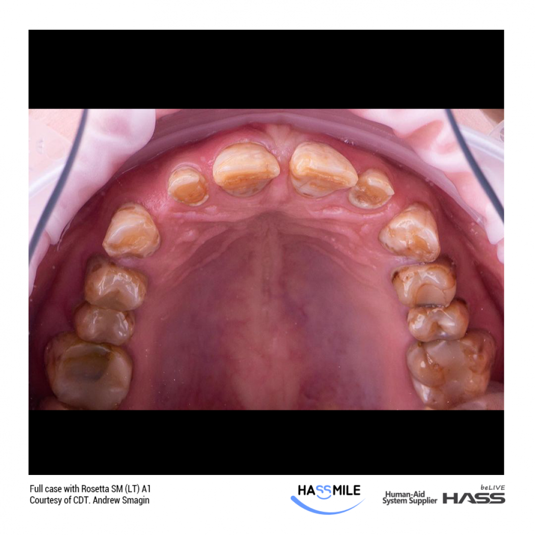 HASSBIO RosettaSM Lithium-disilicate CAD CAM