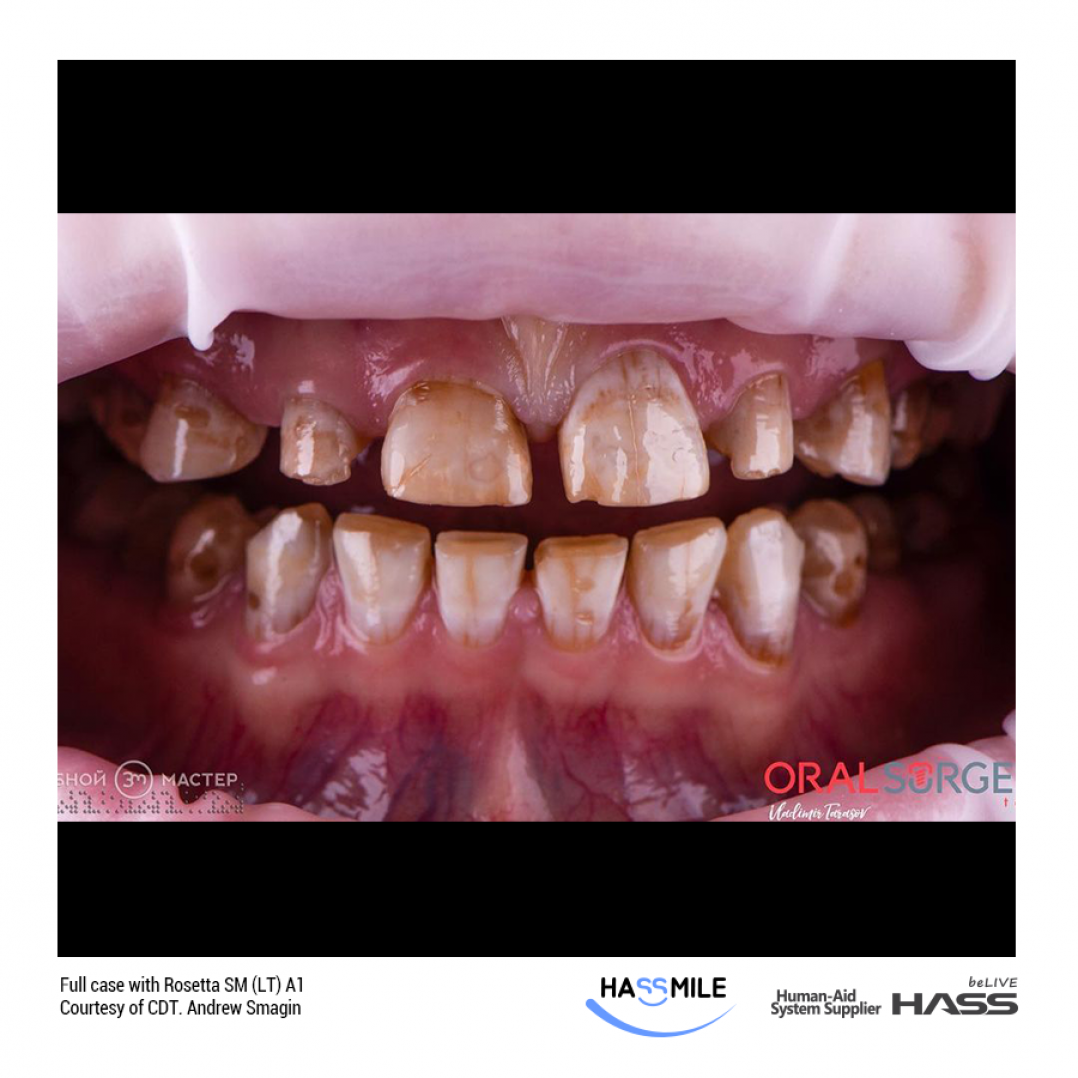 HASSBIO RosettaSM Lithium-disilicate CAD CAM