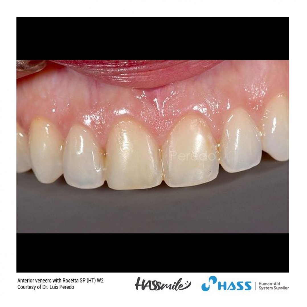 HASSBIO RosettaSP dentalpressingots lithium-disilicate