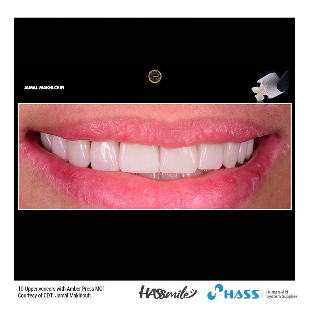 HASSBIO AmberPress dental-press Lithium-disilicate HASSveneers