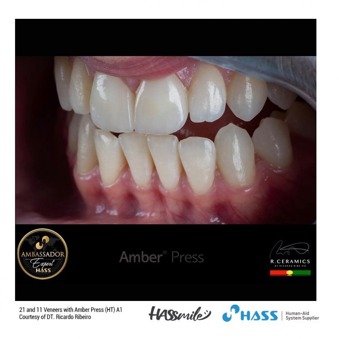 HASSBIO AmberPress Lithium-disilicate dental-press glassceramicingots HASSveneers