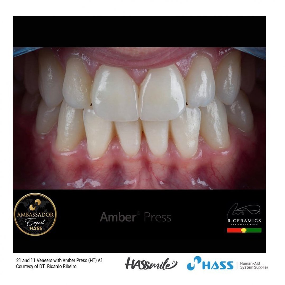 HASSBIO AmberPress Lithium-disilicate dental-press glassceramicingots HASSveneers