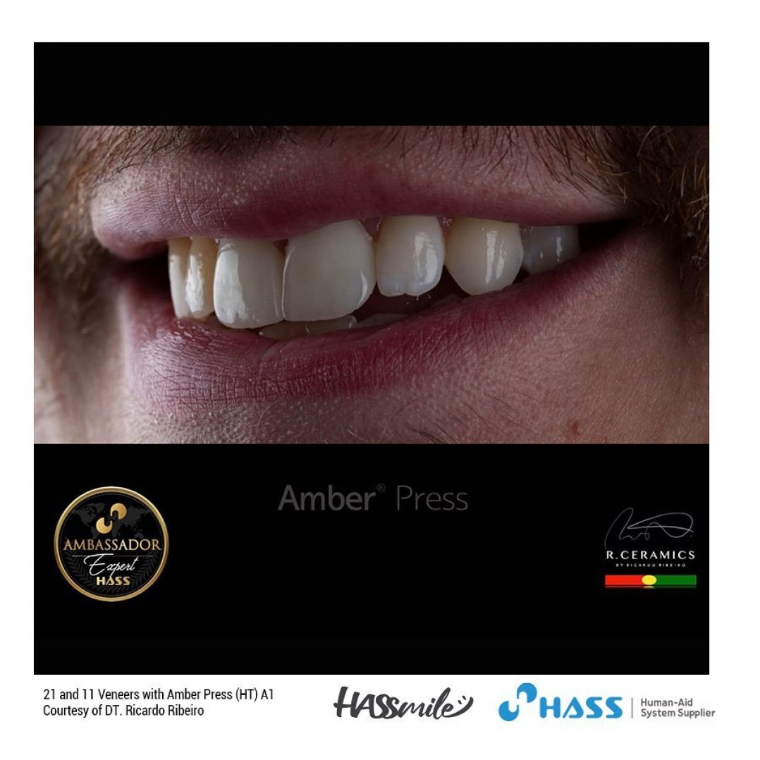 HASSBIO AmberPress Lithium-disilicate dental-press glassceramicingots HASSveneers