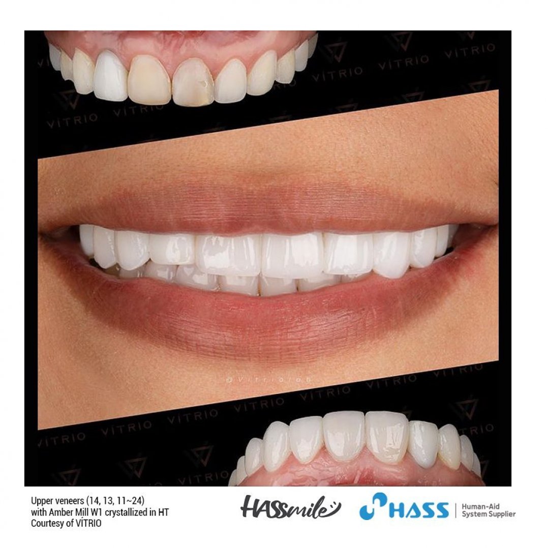 HASSBIO AmberMill NLD Lithium-disilicate dentalcadcam hassveneers aestheticveneers