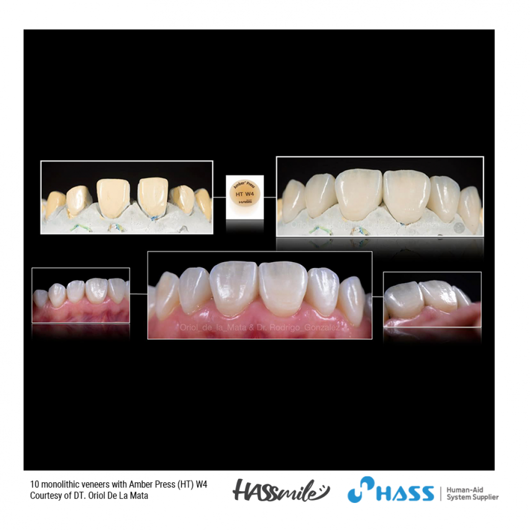 10 monolithic veneers with Amber Press (HT) W4